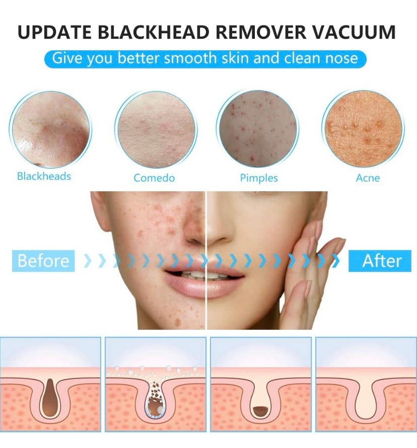 Blackhead Remover Pore Vacuum