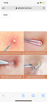 Blackhead Remover Kit